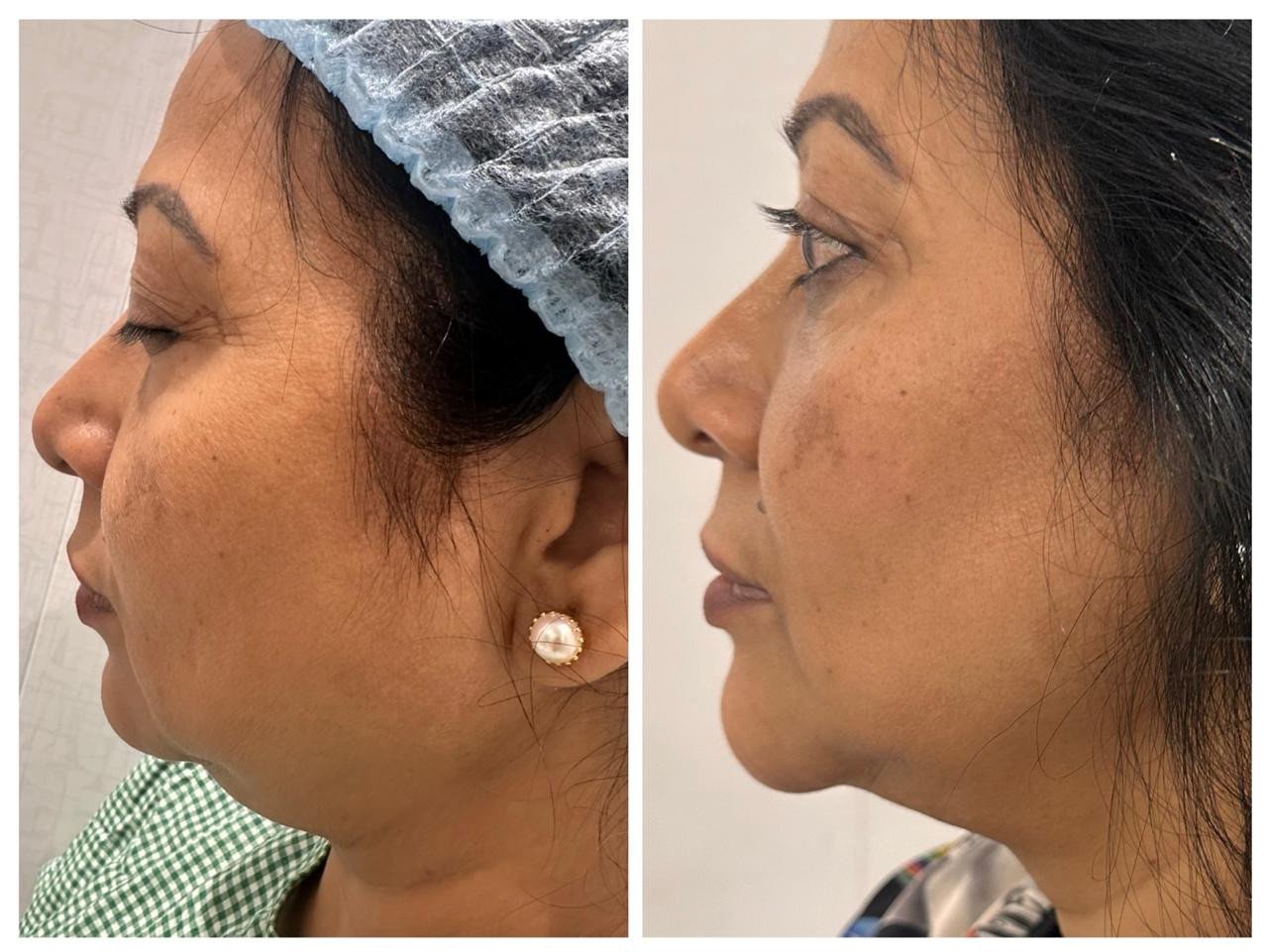 Chin Implant Surgery Before and After